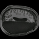 Escáner de un cerebro adulto que sufrió una hemisferectomía durante la niñez.
Imagen: Caltech Brain Imaging Center